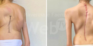 Scoliosi grave, intervento di correzione per una 15enne, prima volta in Italia combinazione di due tecniche