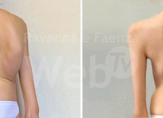 Scoliosi grave, intervento di correzione per una 15enne, prima volta in Italia combinazione di due tecniche