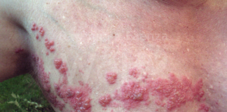 Herpes Zoster: vaccinazione gratuita anche per la popolazione vulnerabile over 18