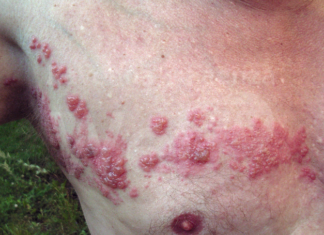 Herpes Zoster: vaccinazione gratuita anche per la popolazione vulnerabile over 18