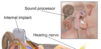 Impianti cocleari: l’ospedale di Ravenna diventa secondo centro in Romagna contro la sordità