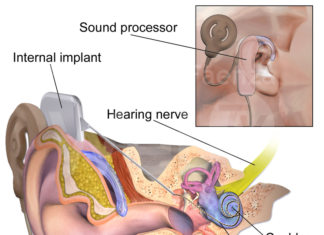 Impianti cocleari: l’ospedale di Ravenna diventa secondo centro in Romagna contro la sordità