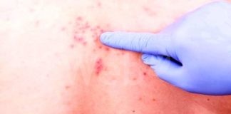 In Ausl Romagna vaccinazione gratuita contro l’HERPES ZOSTER (Fuoco di S. Antonio).