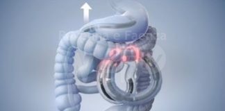 Congresso nazionale Gastroenterologia: presentati i risultati dell’impiego dell’enteroscopia a spirale motorizzata all’ospedale di Ravenna