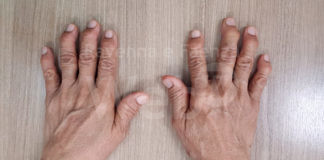 “Psoriasi cutanea e artrite psoriasica: due facce della stessa medaglia”. Un congresso a Ravenna