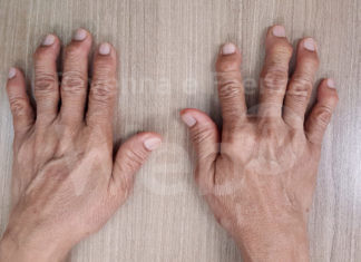 “Psoriasi cutanea e artrite psoriasica: due facce della stessa medaglia”. Un congresso a Ravenna