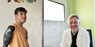 Braccio bionico: a Cotignola un intervento per controllare l’arto artificiale