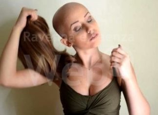 Alopecia areata grave, al via le domande di contributo per l’acquisto della parrucca, fino a 400 euro per paziente