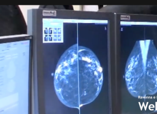 Diminuiscono incidenza e mortalità dei tumori al colon retto, al collo dell’utero e al seno