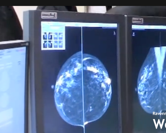 Diminuiscono incidenza e mortalità dei tumori al colon retto, al collo dell’utero e al seno