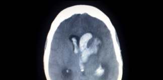 Prevenzione contro l’ictus cardioembolico cerebrale: incontro organizzato dai Lions