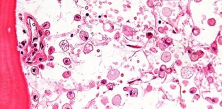 Malattie lisosomiali: la Regione riattiva il gruppo di lavoro con professionisti e associazioni dei pazienti